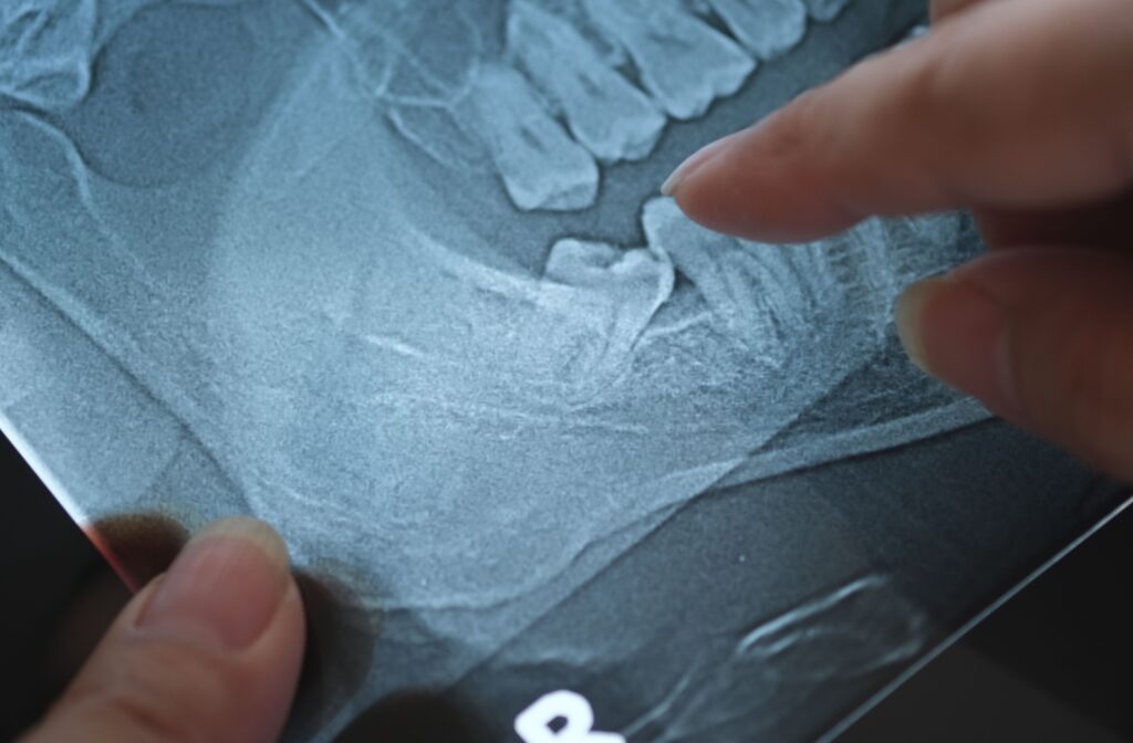A close up of a dental x-ray showing a wisdom tooth